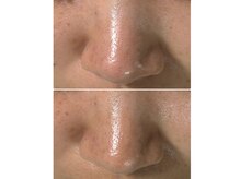 アカラ(Akara)/隠せない毛穴汚れ、開きにも◎