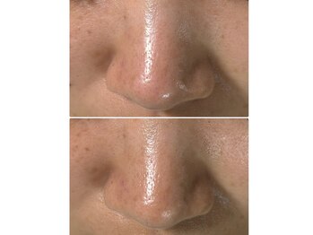 アカラ(Akara)/隠せない毛穴汚れ、開きにも◎