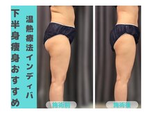 ナナ 銀座(Nana)/お尻の凸凹を解消したい方へ