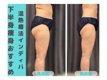 ナナ 銀座(Nana)/お尻の凸凹を解消したい方へ