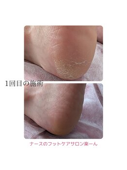 楽ーん/踵のひび割れ！改善施術事例♪