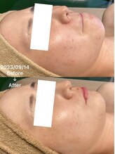 リリアン(Re:lien)/ハーブピーリング