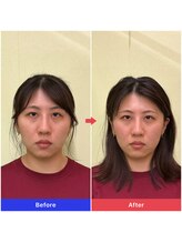 天空の手もみ/面長矯正【1回目】初回