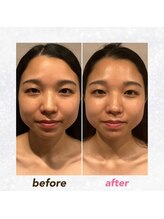 グレースフィオーレ 南越谷店(gracefiore)/リフトアップ｜小顔｜たるみ改善