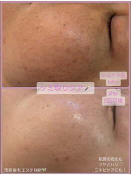 フェアリー/シミケア取り放題!