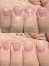 マリーロール 淀屋橋本店(Marie Laure)/自爪育成/深爪矯正/ネイルケア