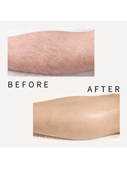 アンビワン(Anbione.)/ひざ下脱毛★