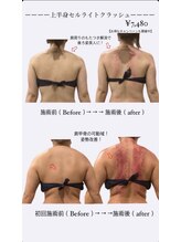 痩身革命 大宮店/ 施術写真（痩身）