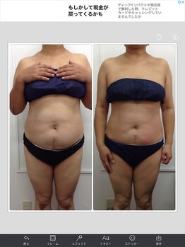 健康痩身研究所 蟹江店/ビフォーアフター