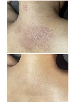 ミーラブ 鹿児島(miilove)/脱毛で背中のくすみ改善