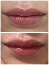 ロワゾーブリュ 代官山店(L'oiseau Bleu)/最新メラニンケア