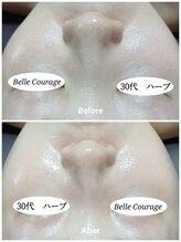 ベルクラージュ(Belle Courage)/30代　毛穴