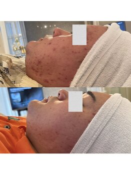 サロン ウェル(SALON WELL)/ 【ハーブピーリング B→A】