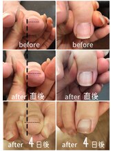 ウェリナ(welina)/ジェルで巻き爪ケア　hey switch