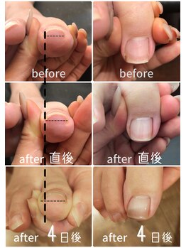 ウェリナ(welina)/ジェルで巻き爪ケア hey switch