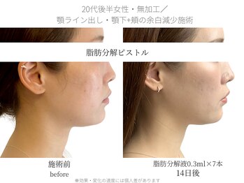 サボラミ(sabor A Mi)/ダウンタイム・施術時の痛み最小