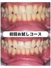 ホワイトニングビューティー 吉祥寺店/ホワイトニング　初来店