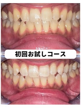 ホワイトニングビューティー 吉祥寺店/ホワイトニング 初来店