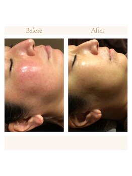 インプレス ラミール/施術1回での変化