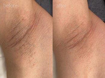 オンセ(once)/ワキ脱毛/全身脱毛