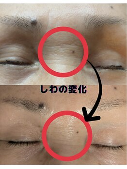 イロドリ(irodori)/眉間のしわ改善♪ハリ復活!!