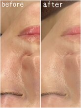 クーレ(CURE)/毛穴洗浄×ハーブピーリング