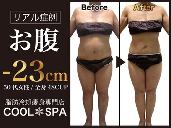 クールスパ(COOL SPA)の写真/ぽっこりお腹集中ケア◎脂肪冷却でお腹引き締めて！天神で目指す、憧れのくびれ作り！