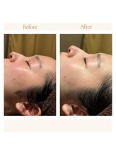 インプレス ラミール/施術1回での変化