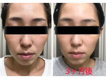 スパチャーレ(Spa ciare)/肌ファス