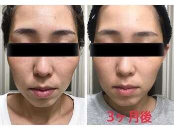 スパチャーレ(Spa ciare)/肌ファス