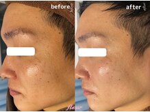 フルール(Fleur)/◆メンズ美容/乾燥/敏感肌改善◆