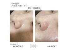 サロンエイトミー 西船橋店(salon 83)/【毛穴ケア】鼻・頬の黒ずみ改善