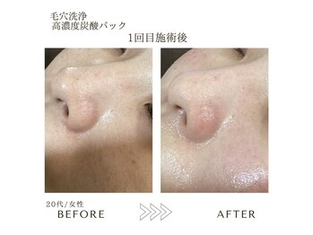サロンエイトミー 西船橋店(salon 83)/【毛穴ケア】鼻・頬の黒ずみ改善
