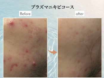 コンフィ(Comfy)/プラズマニキビ