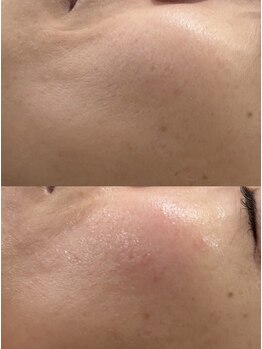 ブレス(Breath)/毛穴、くすみ、肌荒れ