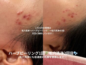 ピブ(pib.)/毛穴洗浄&ハーブピーリング