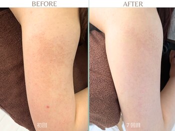 エミルカ 日の出平井店(EMILUCA)/二の腕の毛孔性苔癬やブツブツ