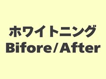 セルフメイド 東大阪店(SELFMADE)/ホワイトニングビフォーアフター