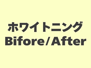 セルフメイド 東大阪店(SELFMADE)/ホワイトニングビフォーアフター