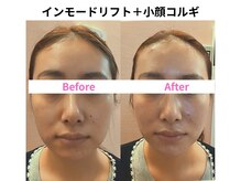 サロン ド シャーロット 恵比寿/＃恵比寿小顔＃インモードリフト