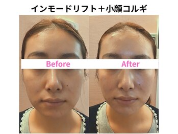サロン ド シャーロット 恵比寿/＃恵比寿小顔＃インモードリフト