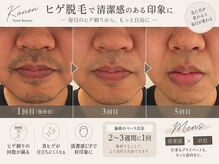 カノン 南熊本店(Kanon)の雰囲気(ひげ脱毛1回目、3回目、5回目の様子です。)