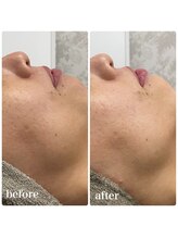 カプリス(CAPRiCE)/BBLフェイシャル