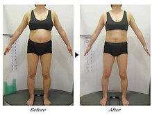 ビューティークリニックコダマ 日向店/【1か月コース】F.N様（45歳）