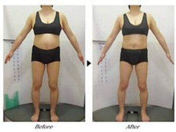 ビューティークリニックコダマ 日向店/【1か月コース】F.N様(45歳)