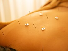 ハリ パール(HARI PEARL)/全身美容鍼灸/コリ解消　背中