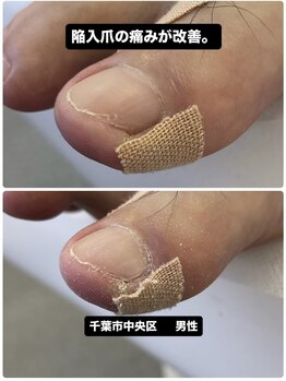 巻き爪じゅん 千葉駅前店/セルフカットで悪化する巻き爪！