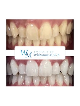 ホワイトニング モア(Whitening MORE)/ビフォーアフター