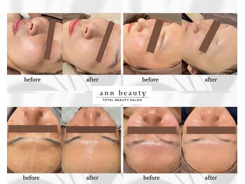 アン ビューティー(ann beauty)