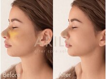 アリリィ(ARILY)/ダウンタイムケア/表参道/外苑前